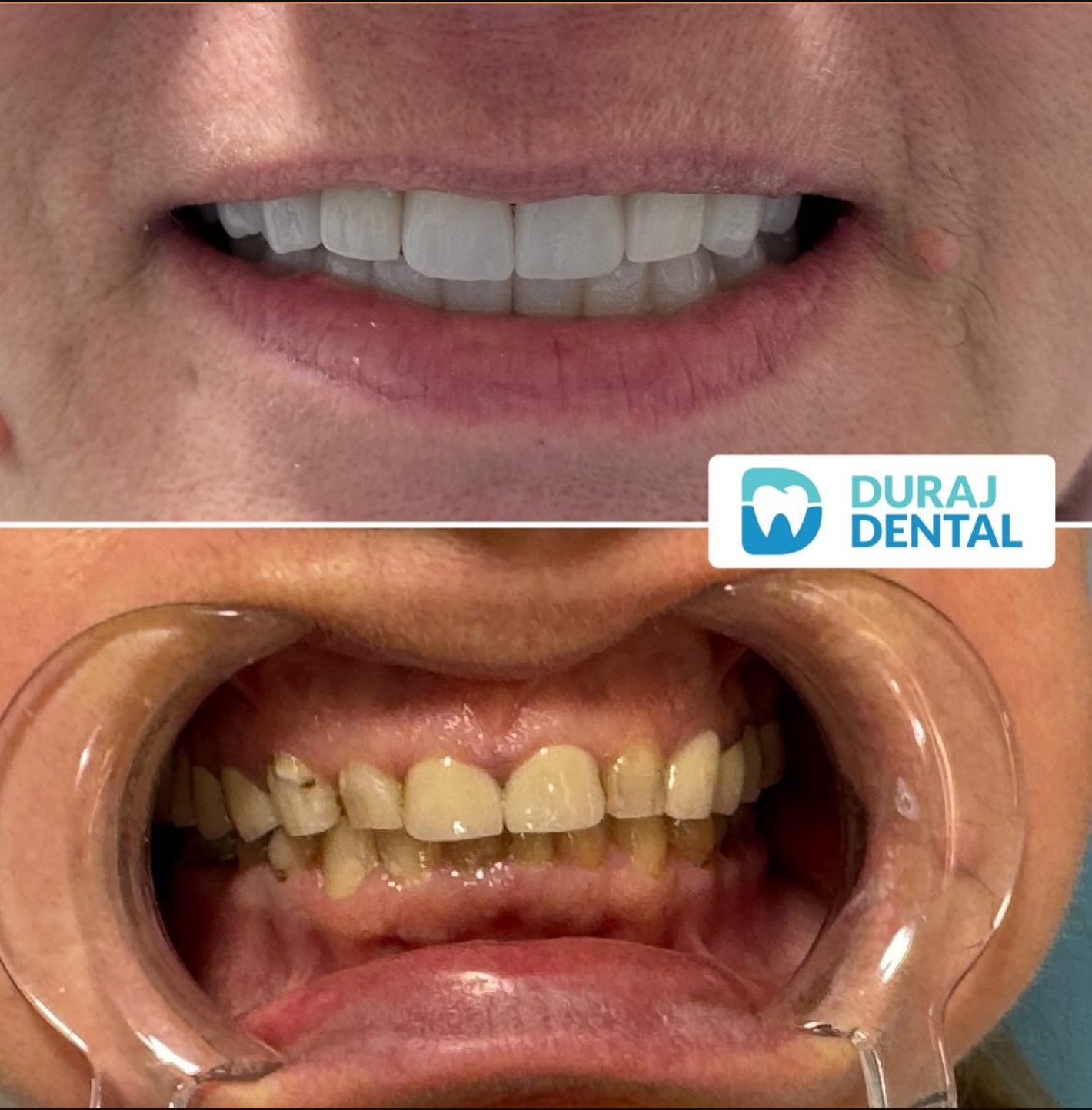 Patient smile transformation 3