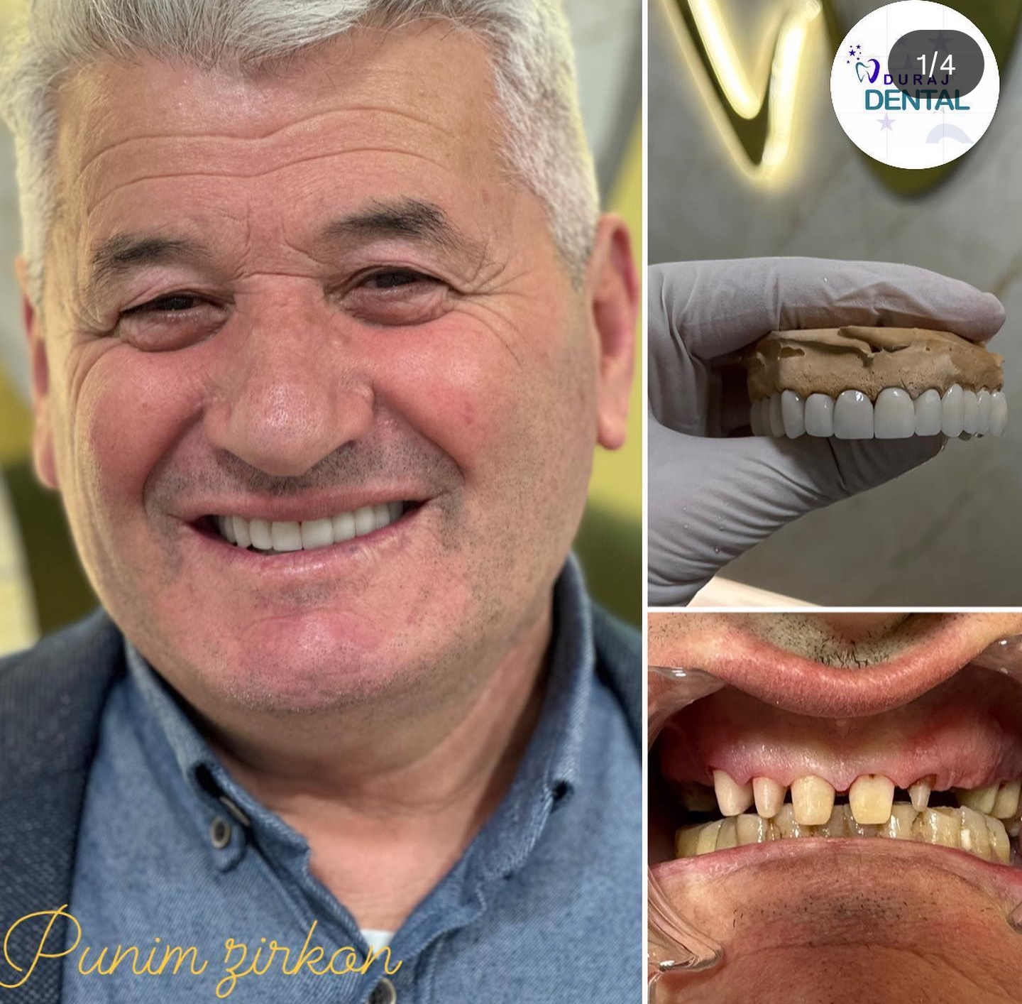 Patient smile transformation 2