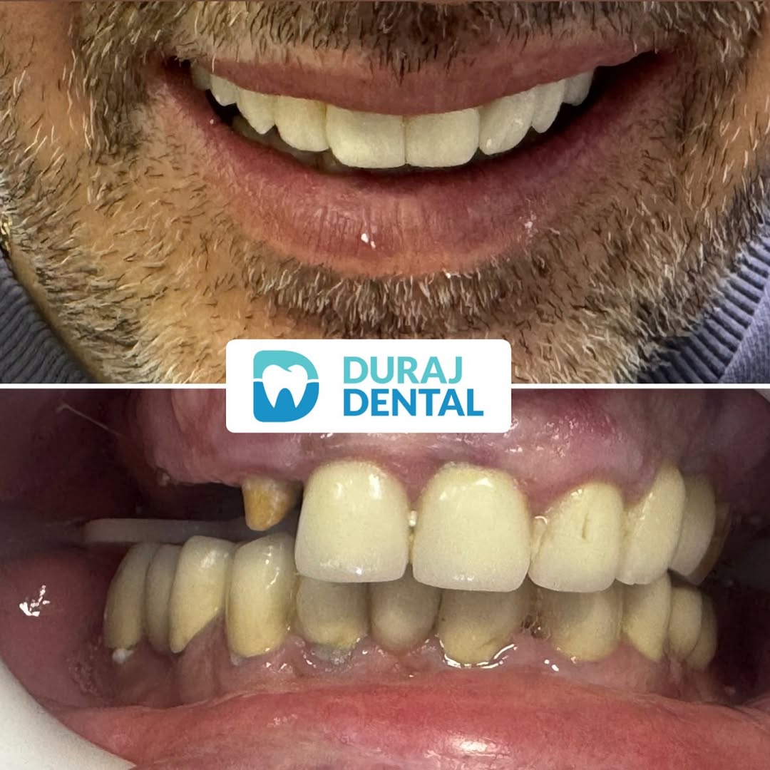 Patient smile transformation 1